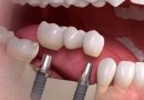 Современные технологии протезирования зубов: качество и эстетика для здоровой улыбки